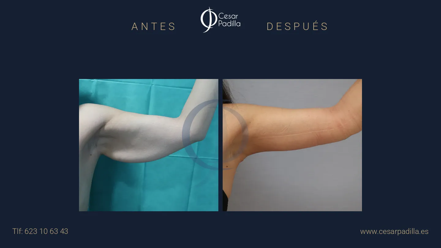 Braquioplastia (brazos)