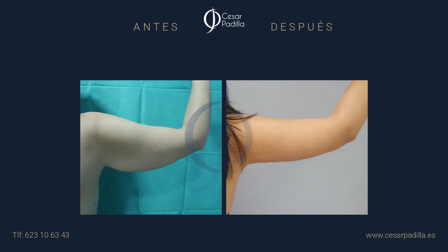 Antes y después de Braquioplastia