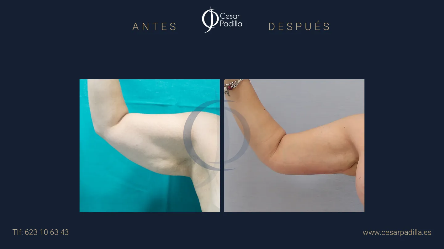 Antes y después de Braquioplastia