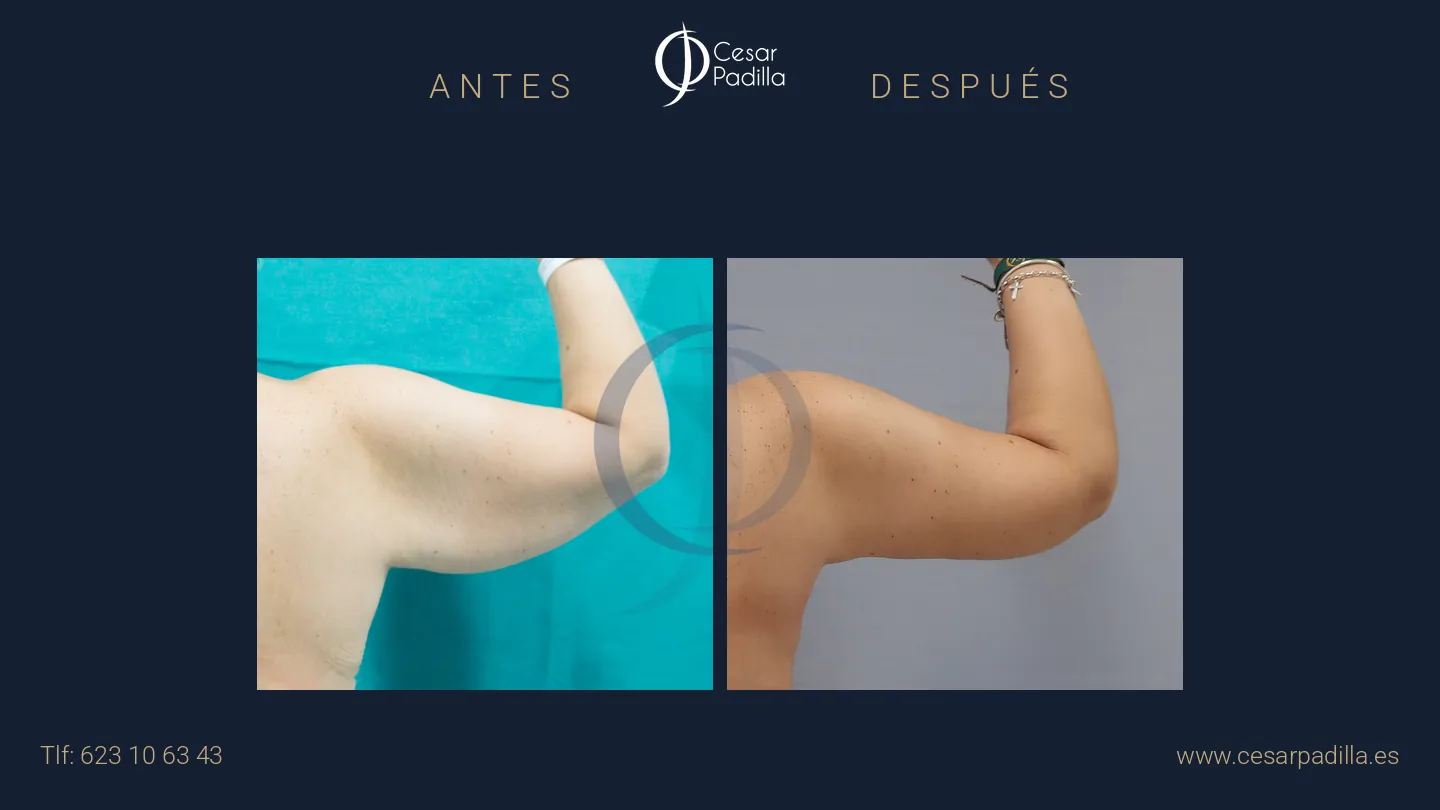 Antes y después de Braquioplastia