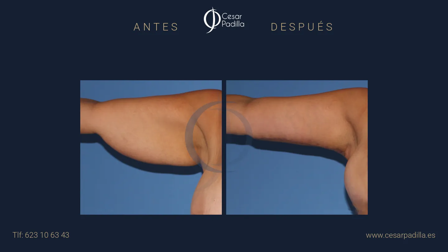 Braquioplastia en Málaga | Dr. César Padilla