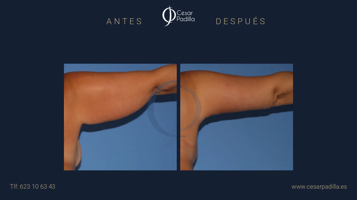 Braquioplastia en Málaga | Dr. César Padilla