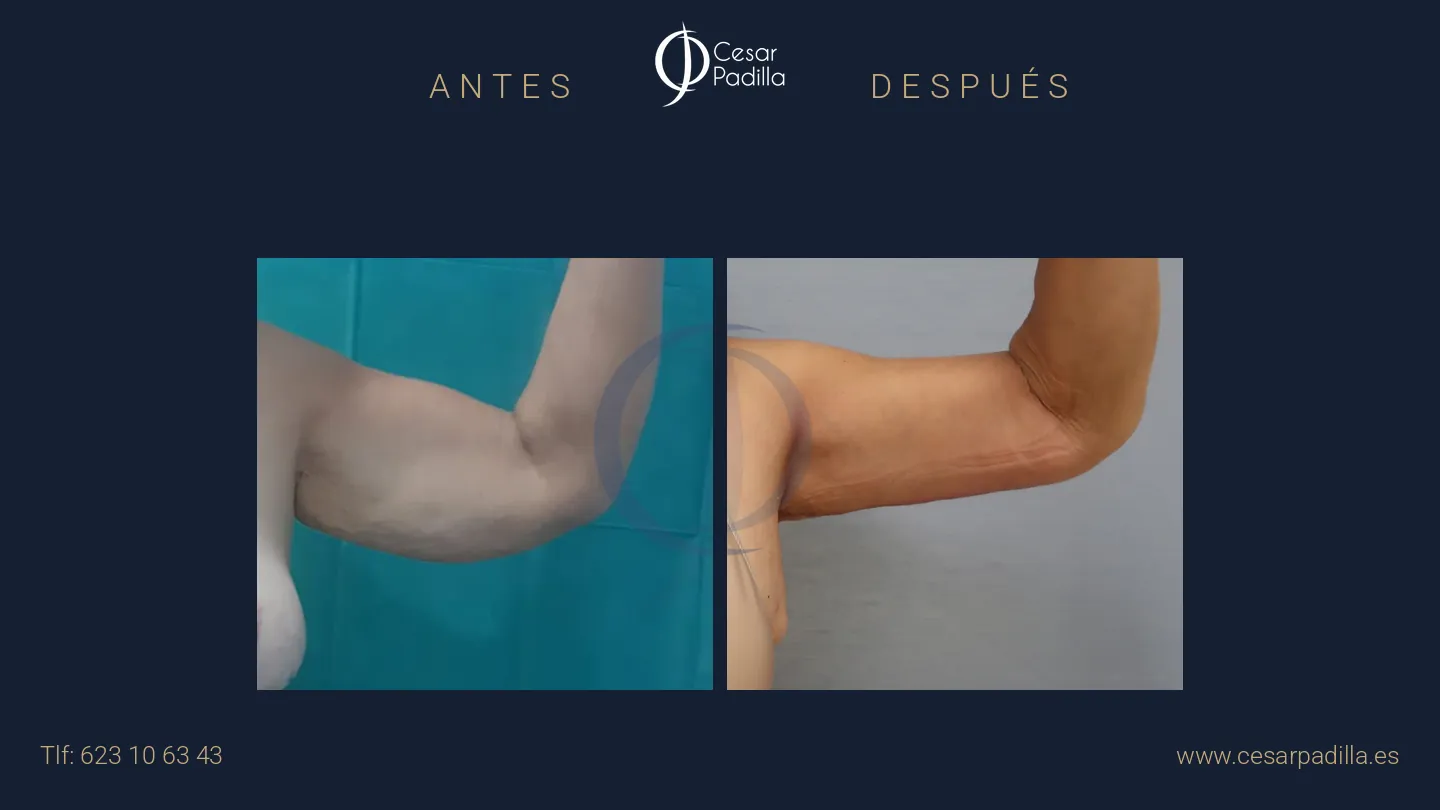 Antes y después de Braquioplastia