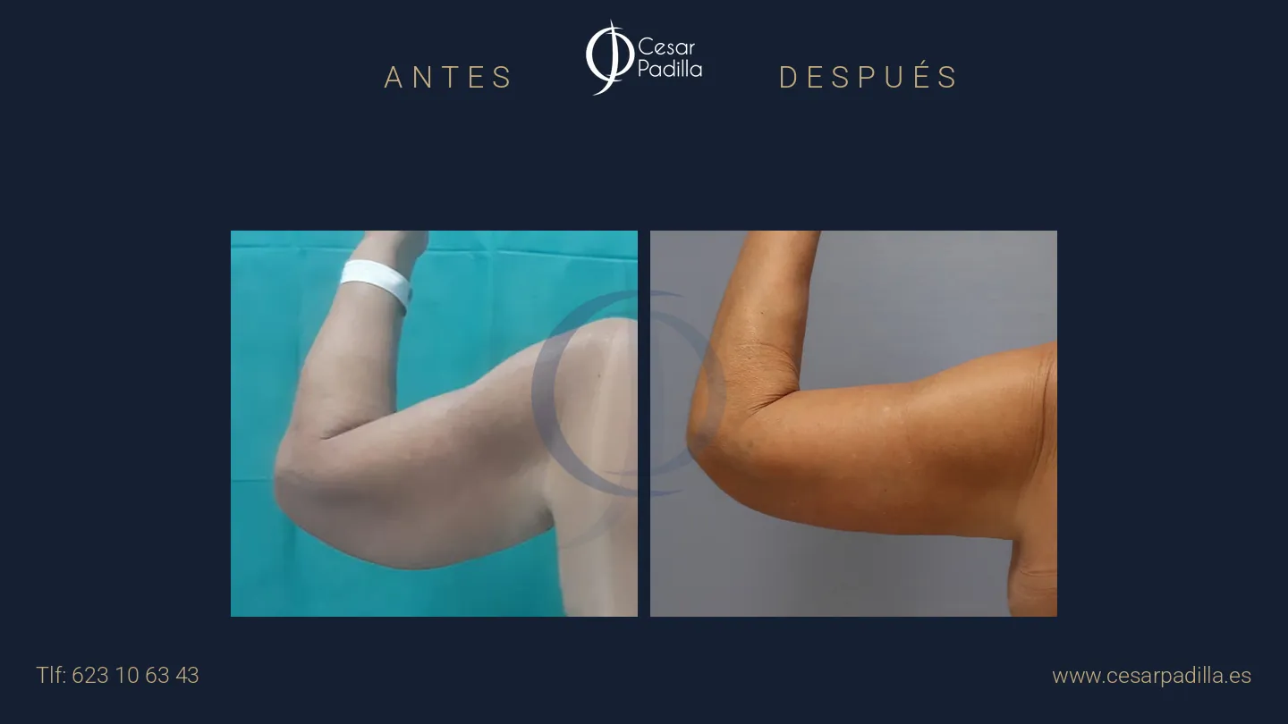 Antes y después de Braquioplastia