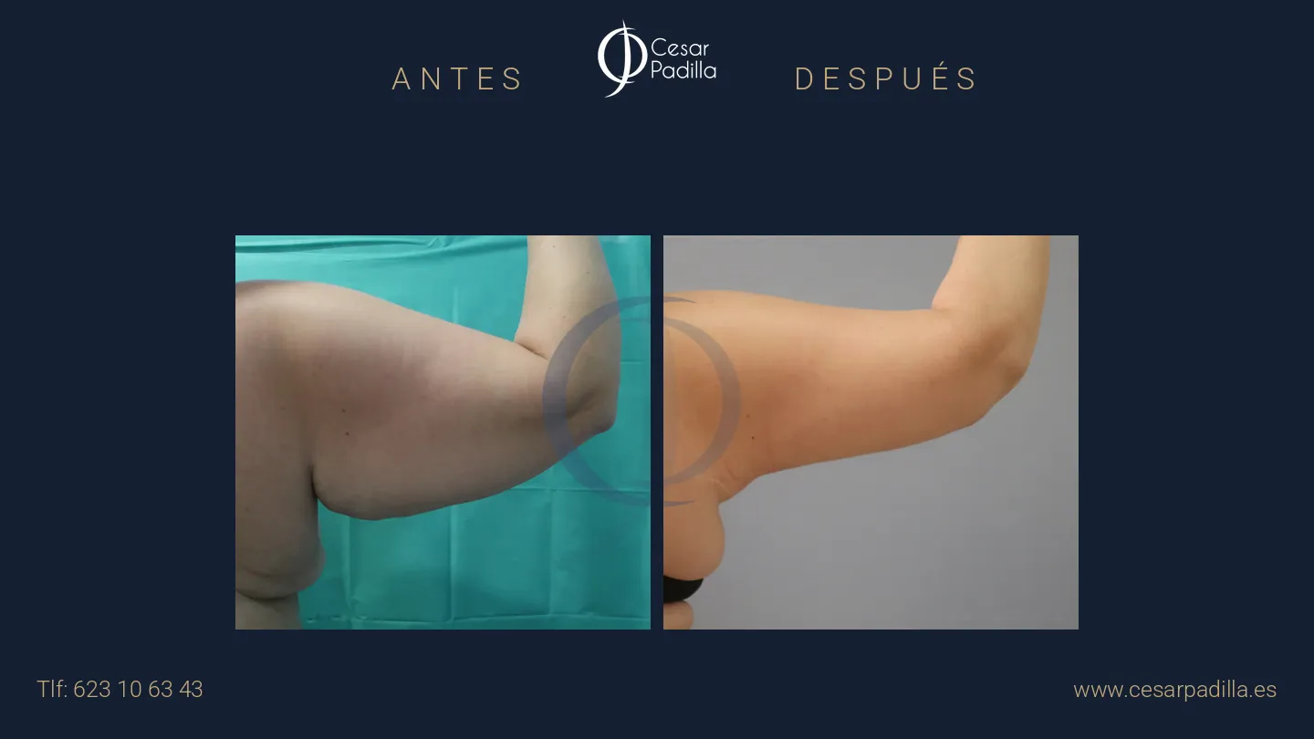 Antes y después de Braquioplastia
