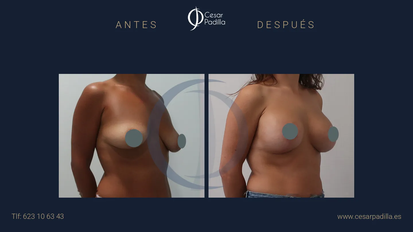 Antes y después de mastopexia con implantes, caso 10