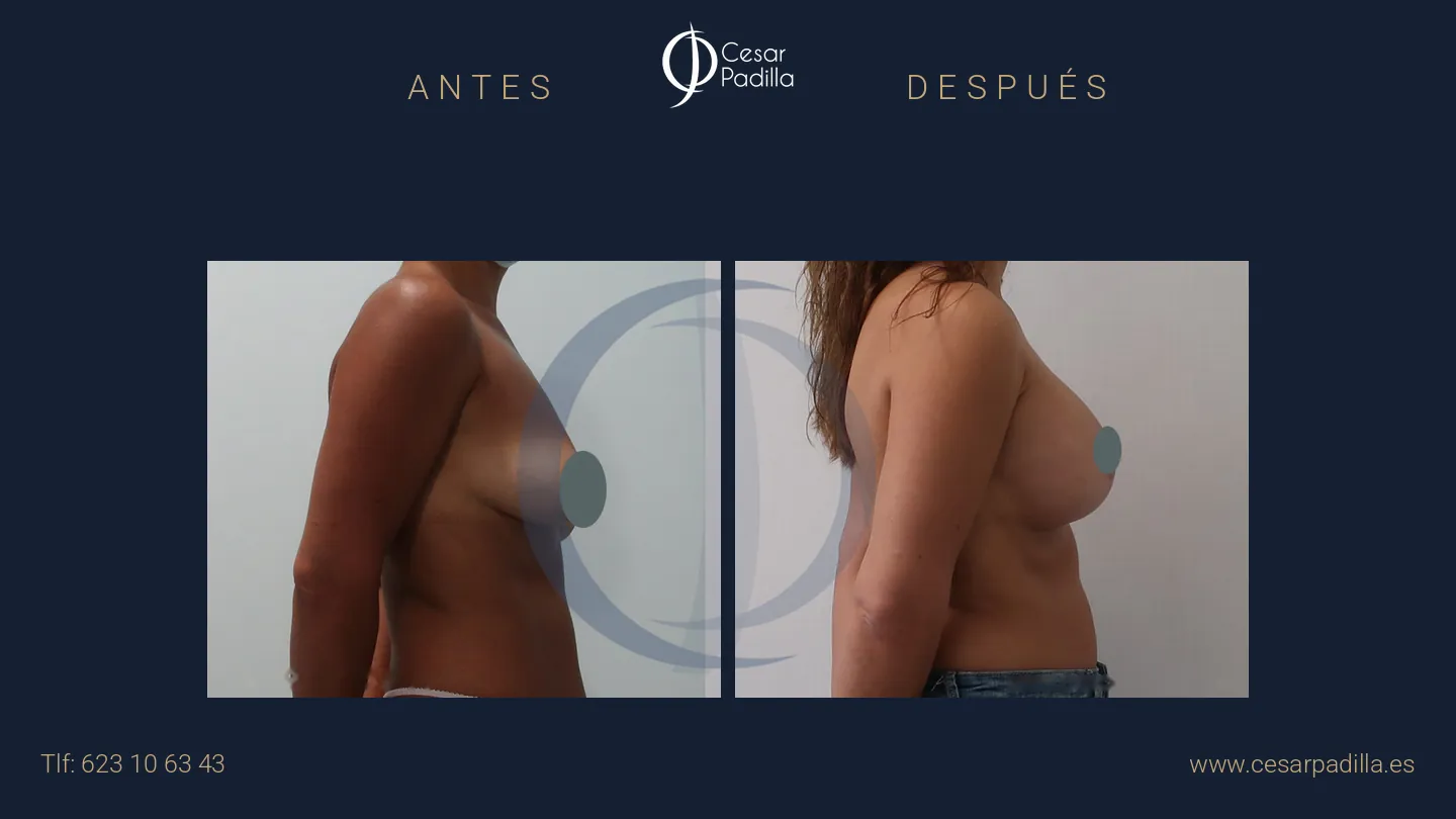 Antes y después de mastopexia con implantes, caso 11