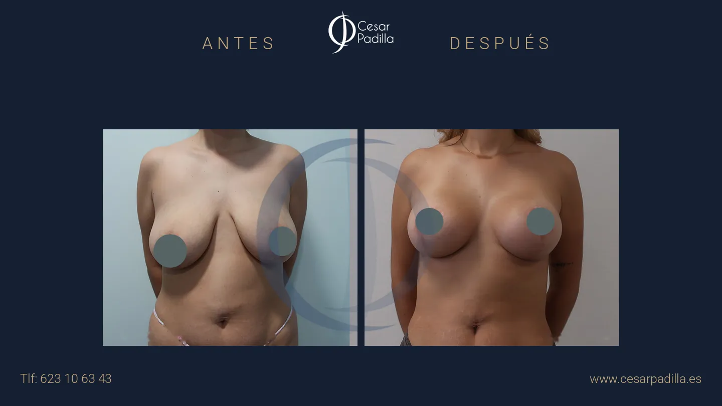 Antes y después de mastopexia con implantes, caso 12