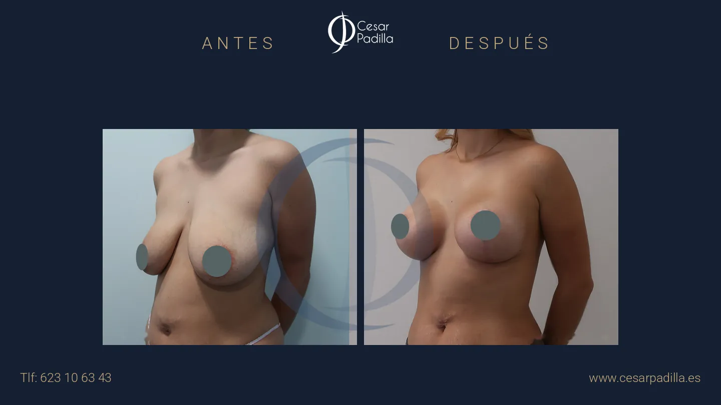 Antes y después de mastopexia con implantes, caso 13