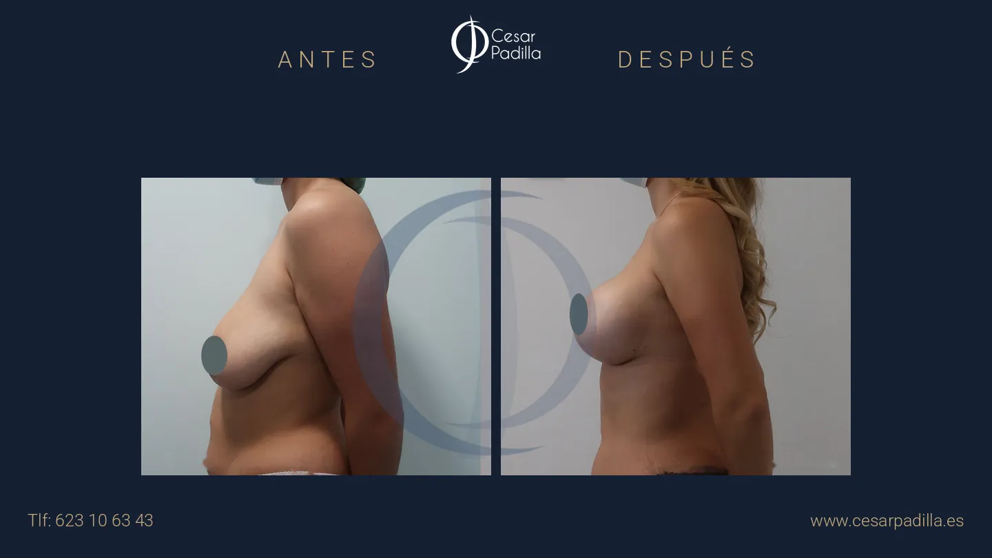 Antes y después de mastopexia con implantes, caso 14