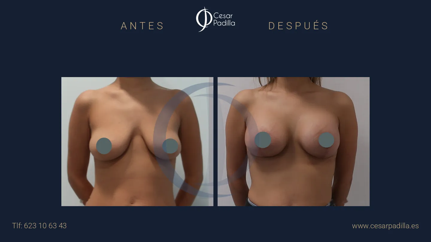 Antes y después de mastopexia con implantes, caso 15