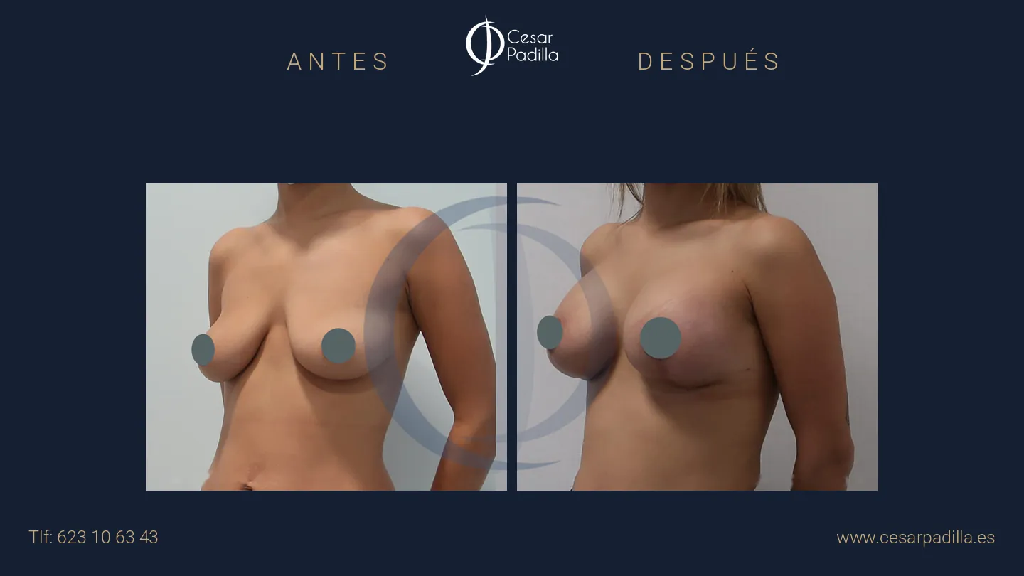Antes y después de mastopexia con implantes, caso 16