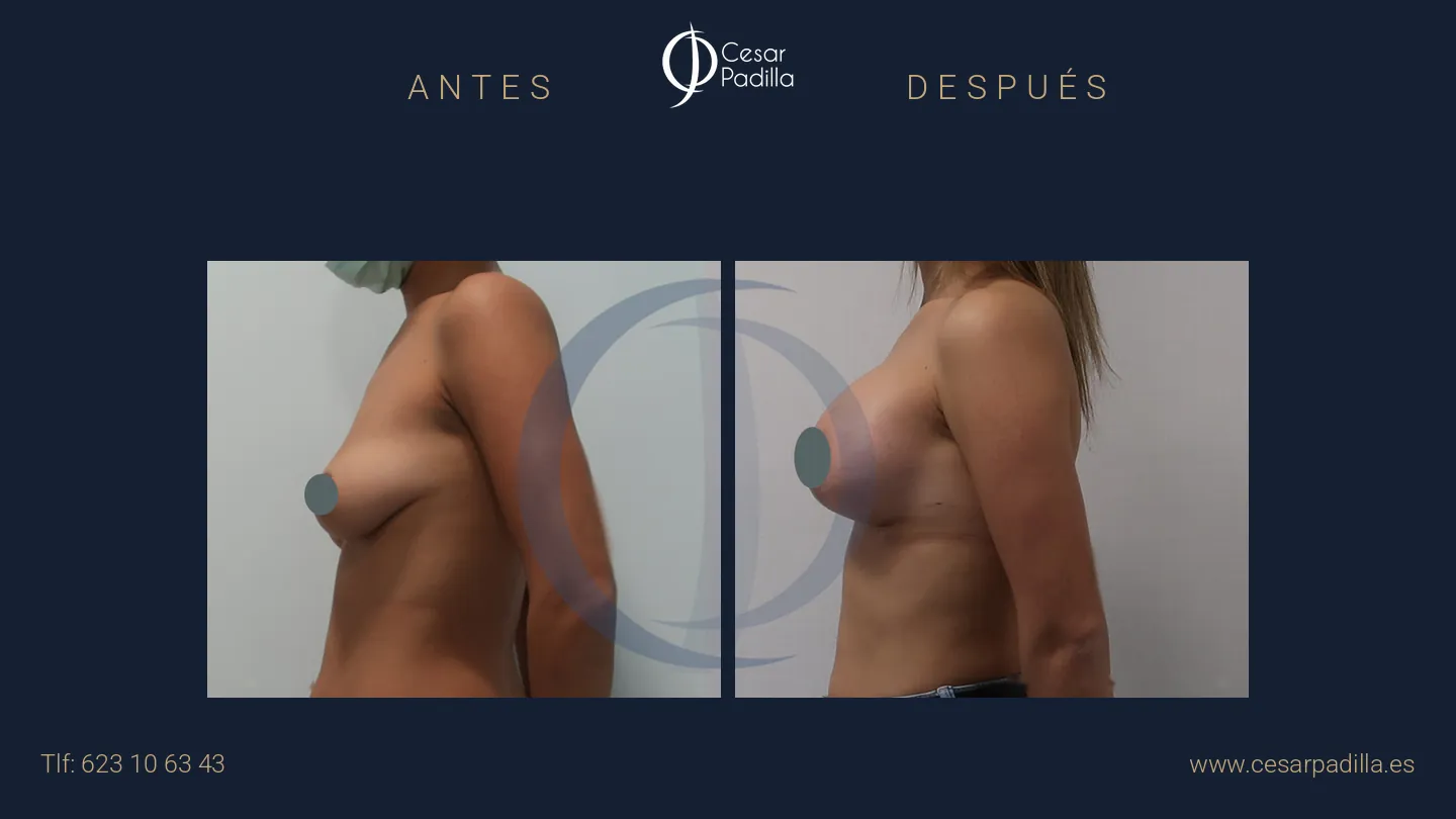 Antes y después de mastopexia con implantes, caso 17