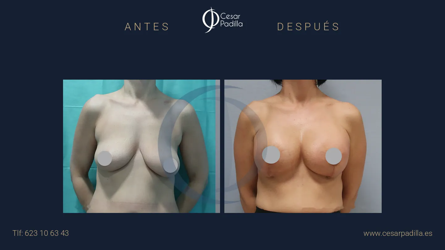 Antes y después de mastopexia con implantes, caso 18