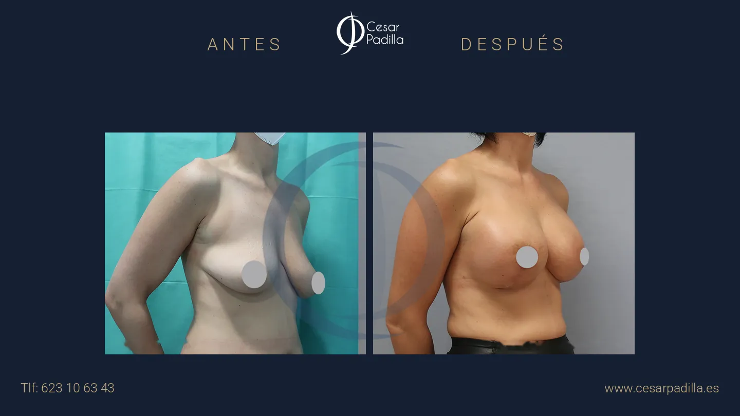Antes y después de mastopexia con implantes, caso 19