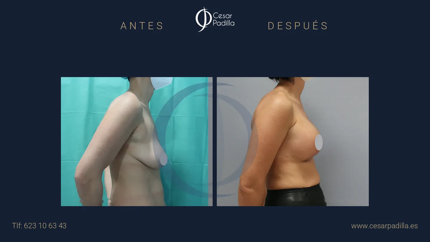 Antes y después de mastopexia con implantes, caso 20