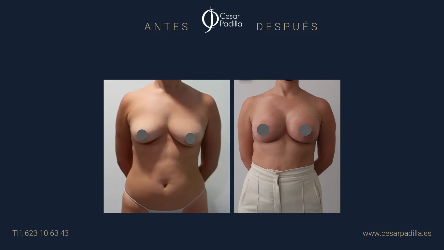 Antes y después de mastopexia con implantes, caso 21