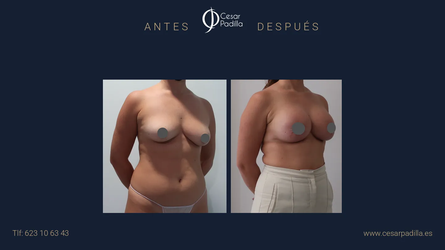 Antes y después de mastopexia con implantes, caso 22