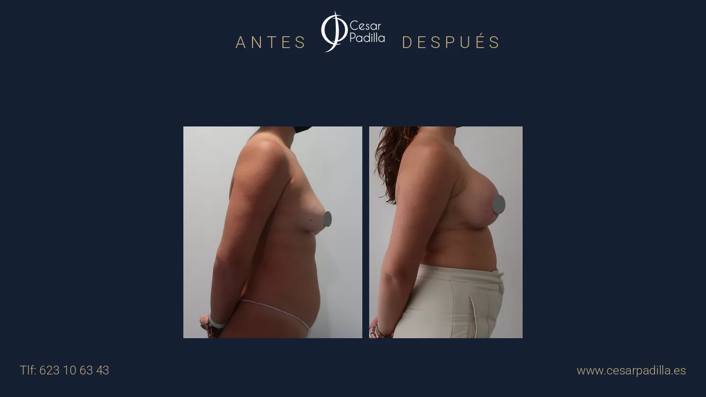 Antes y después de mastopexia con implantes, caso 23