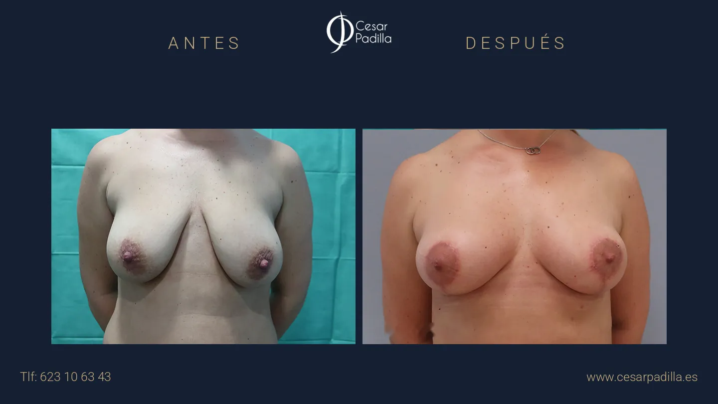 Antes y después de Mastopexia con implantes