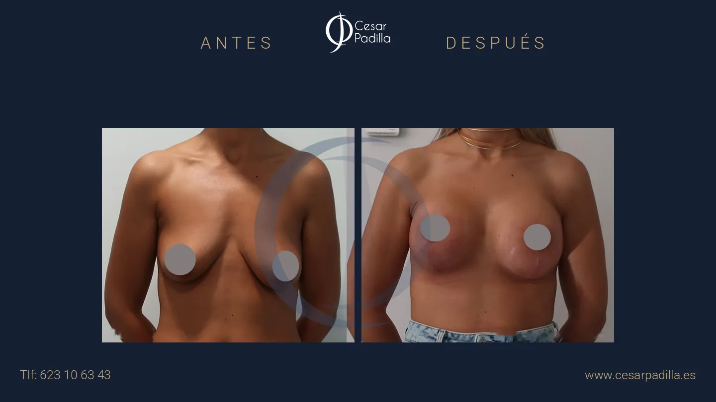 Antes y después de Mastopexia con implantes