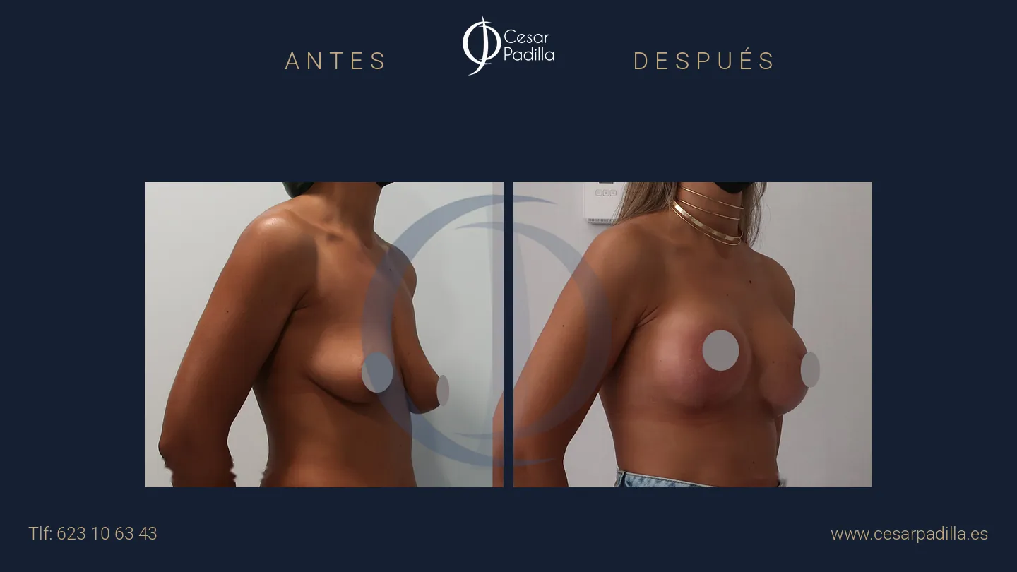 Antes y después de Mastopexia con implantes