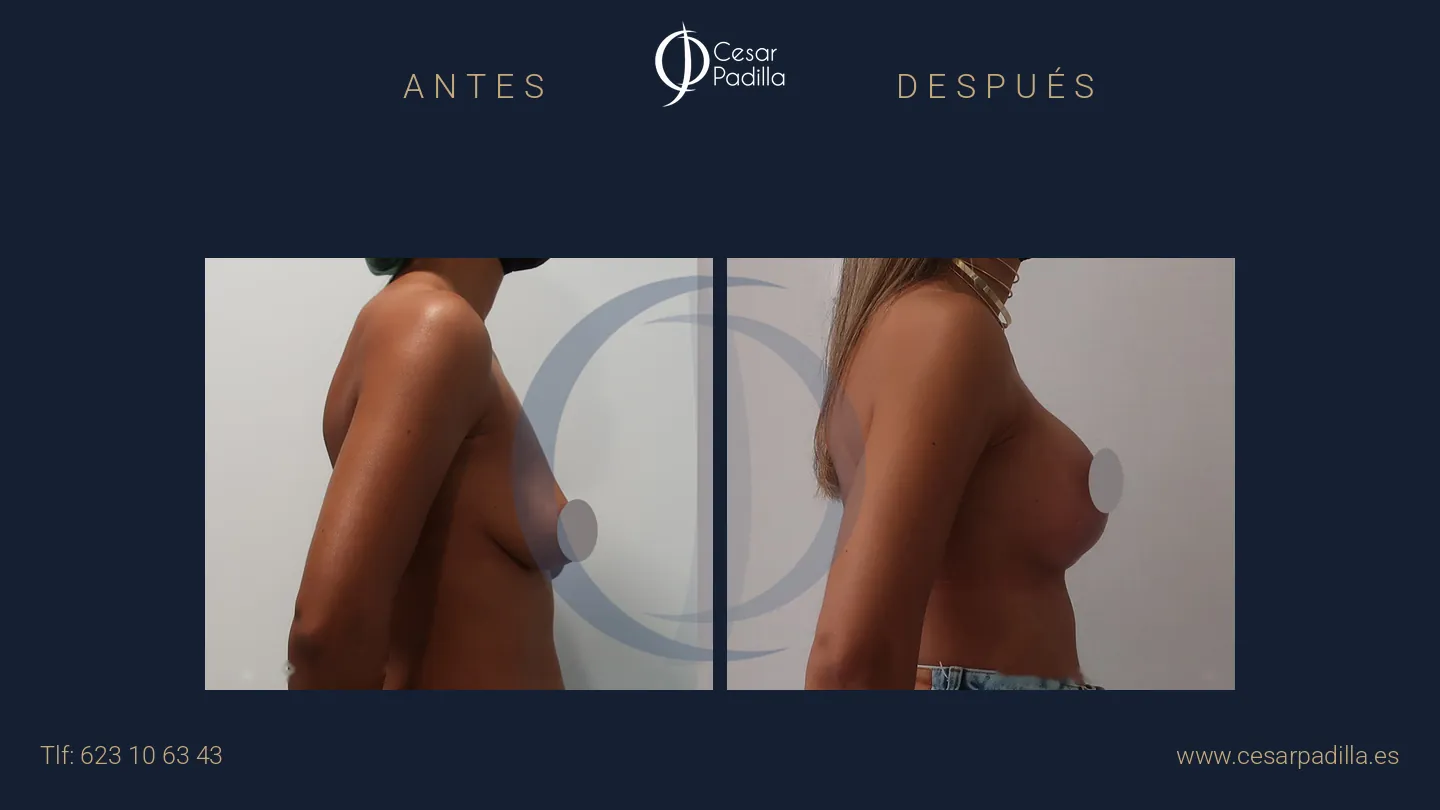 Antes y después de Mastopexia con implantes