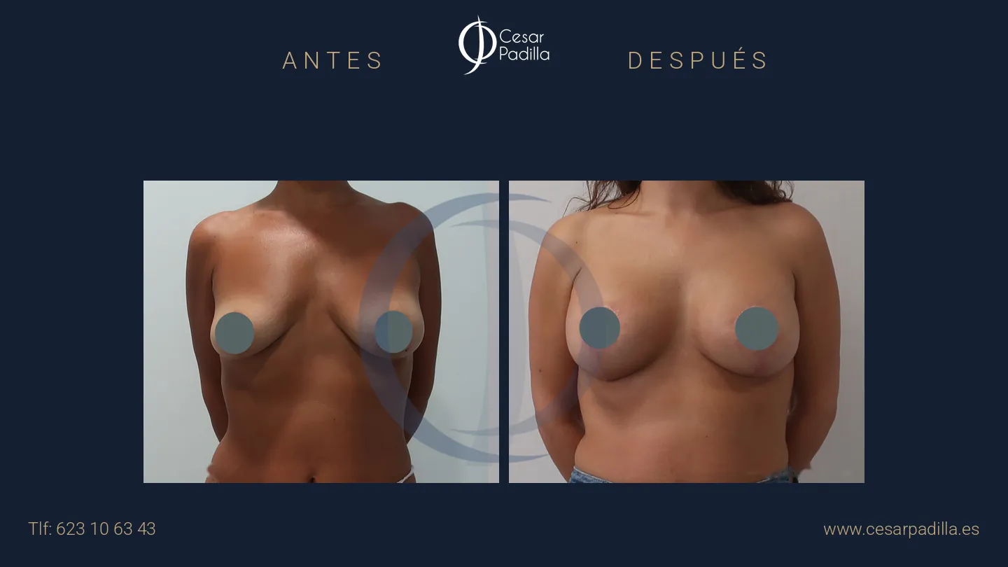 Antes y después de Mastopexia con implantes