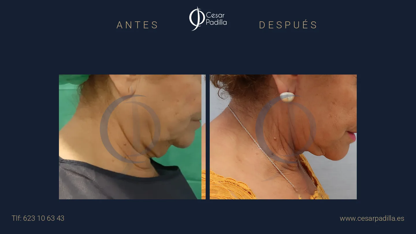 Antes y después de Lifting de cuello y papada