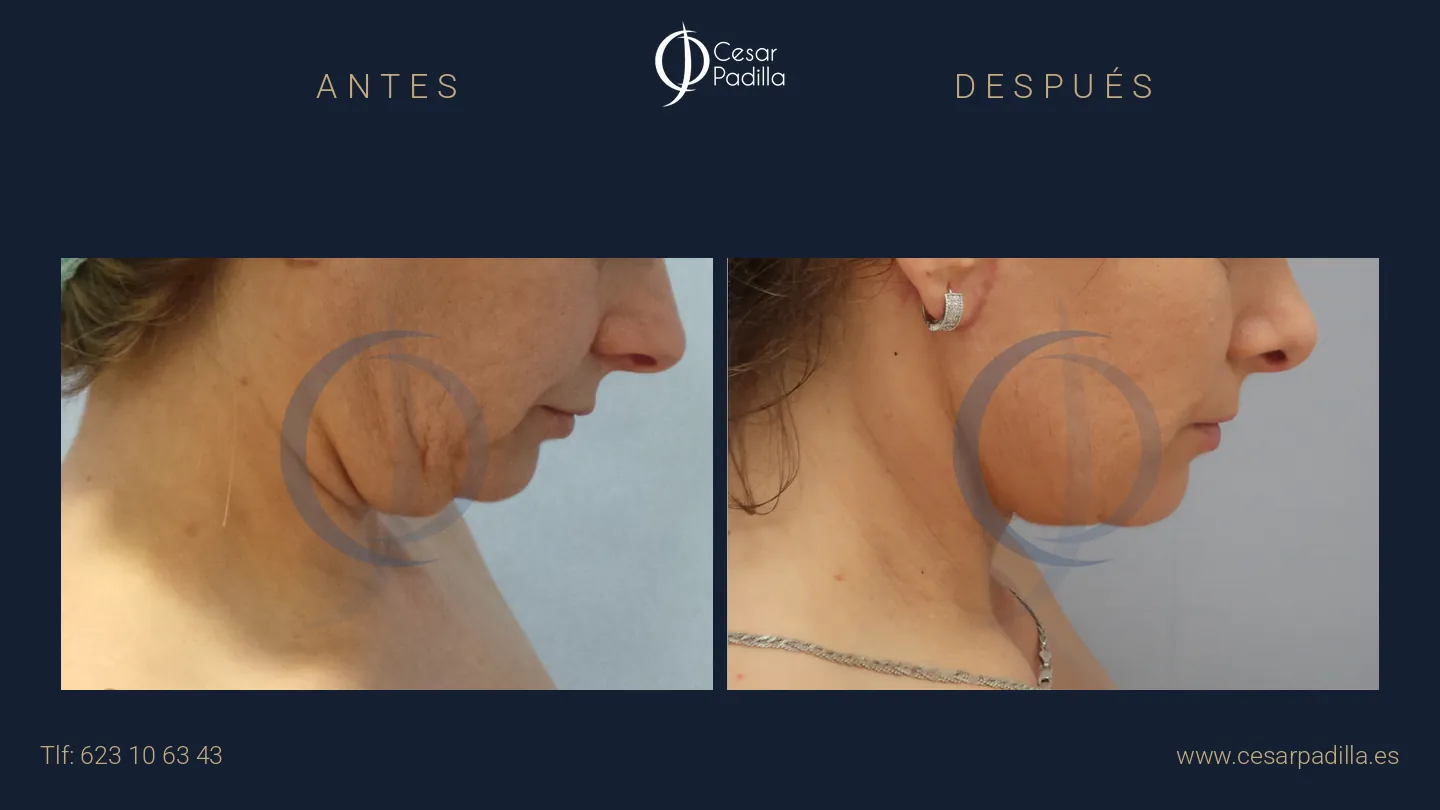 Antes y después de Lifting de cuello y papada