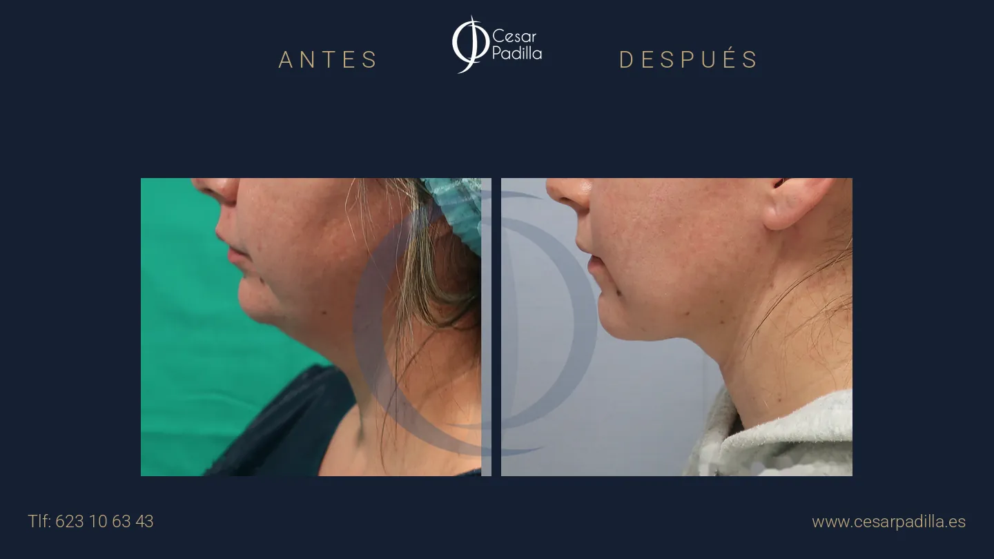 Antes y después de Lifting de cuello y papada