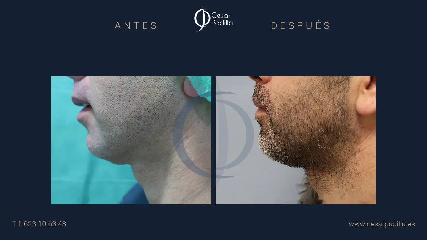 Antes y después de Lifting de cuello y papada