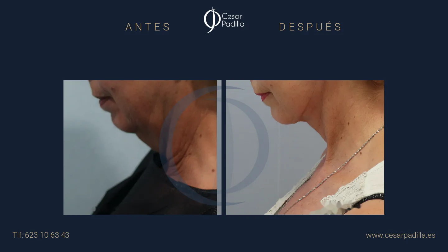 Antes y después de Lifting de cuello y papada