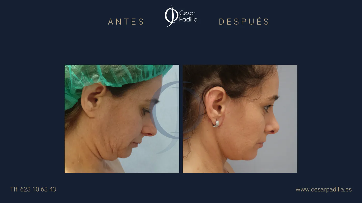 Antes y después de Lifting de cuello y papada