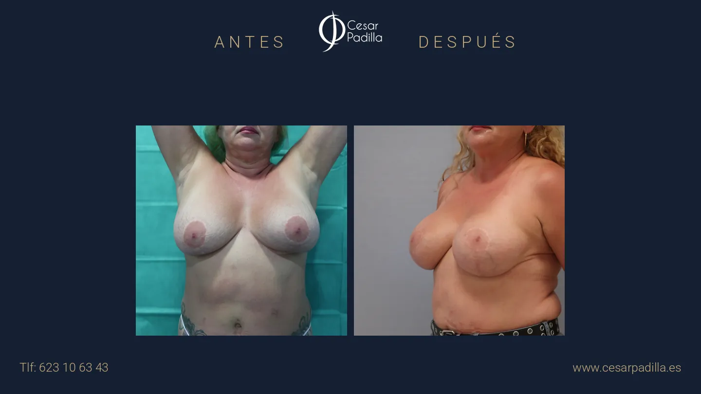 Antes y después de Explantación mamaria