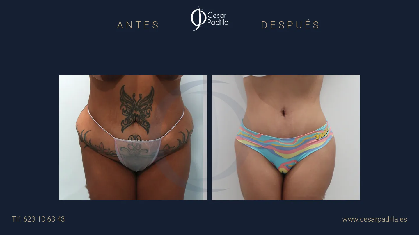 Antes y después de abdominoplastia Flor de Lis, caso 1