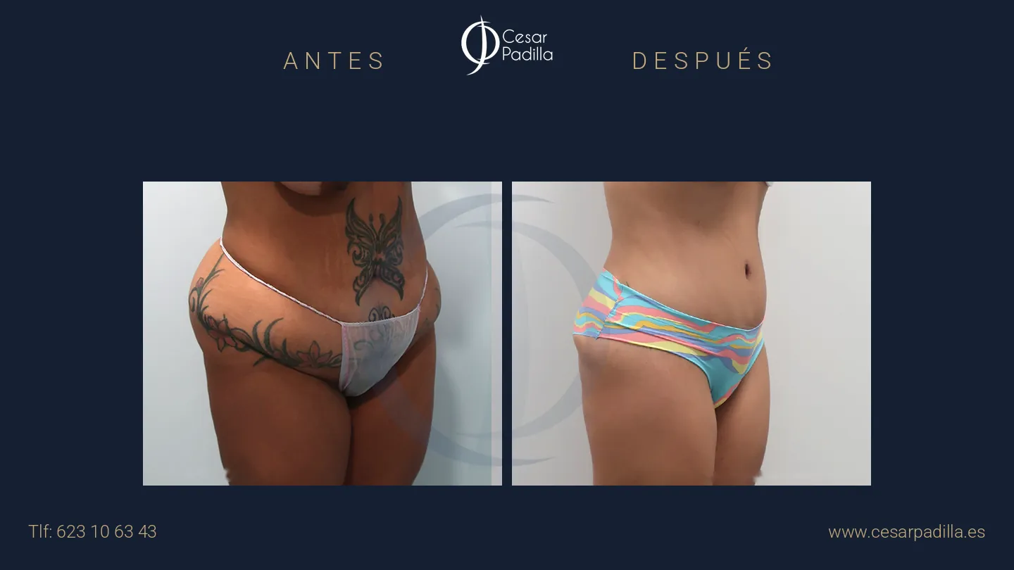 Antes y después de abdominoplastia Flor de Lis, caso 2