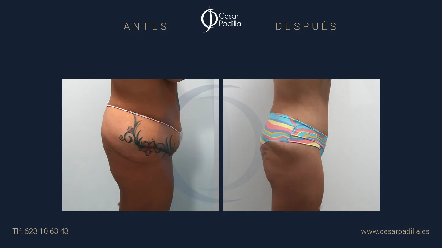 Antes y después de abdominoplastia Flor de Lis, caso 3