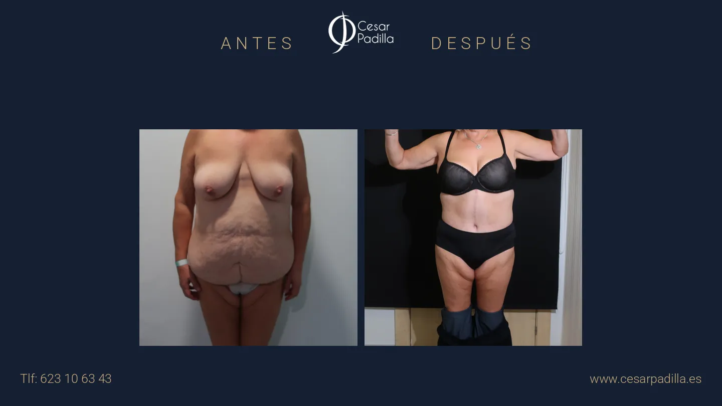 Antes y después de abdominoplastia Flor de Lis, caso 4