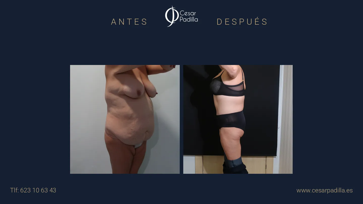 Antes y después de abdominoplastia Flor de Lis, caso 5