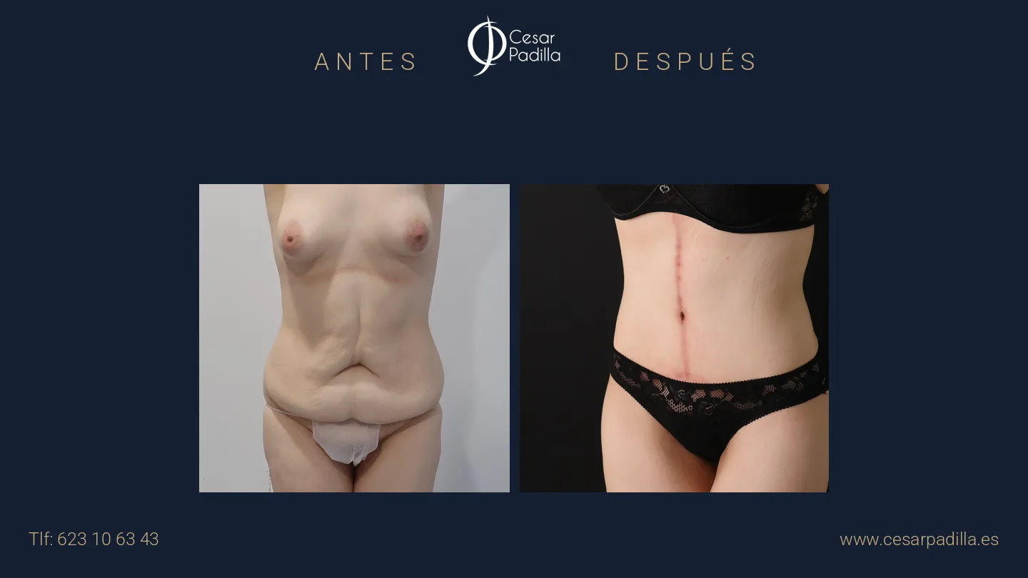 Antes y después de abdominoplastia Flor de Lis, caso 6