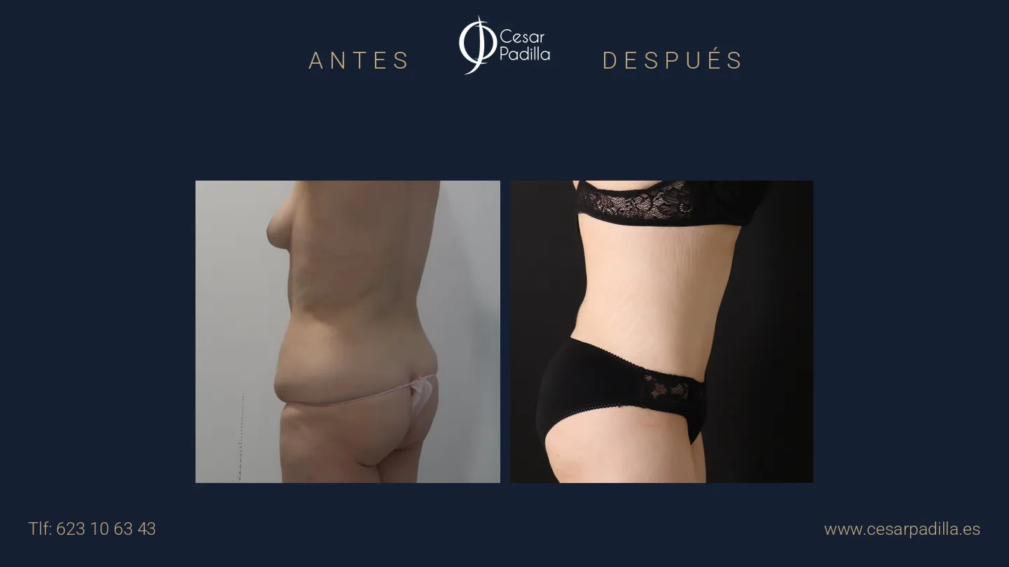 Antes y después de abdominoplastia Flor de Lis, caso 7