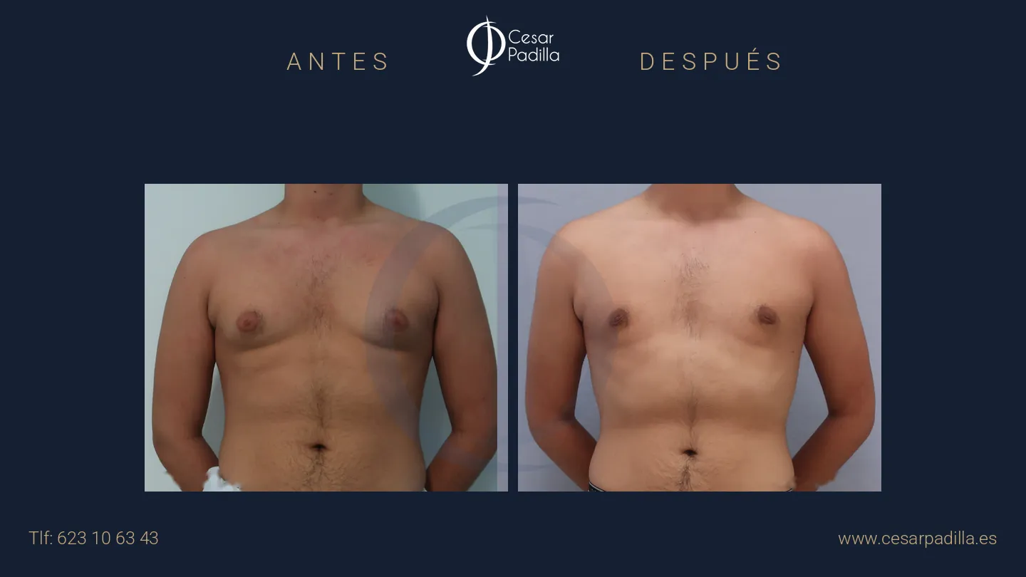 Antes y después de ginecomastia, caso 1