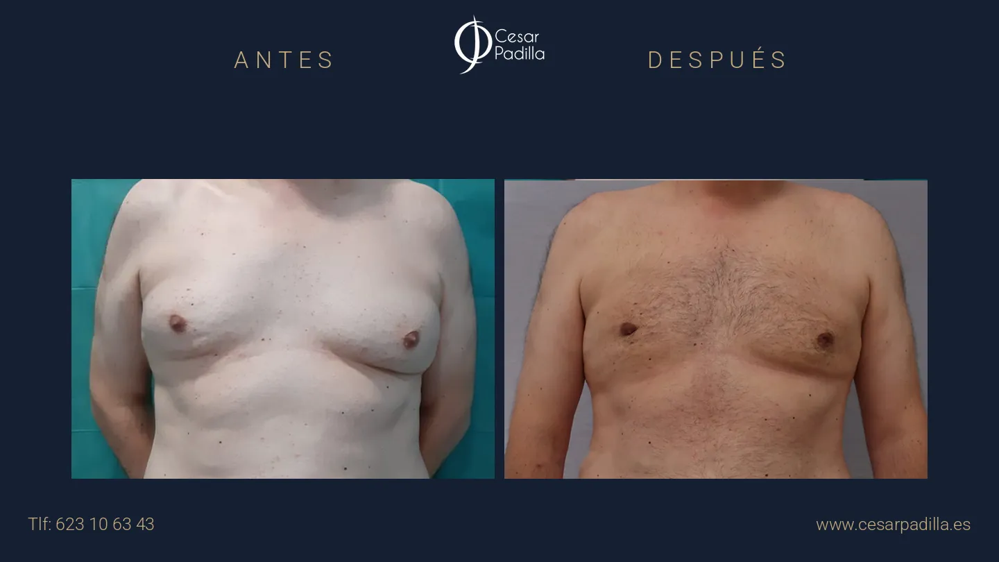Antes y después de ginecomastia, caso 10