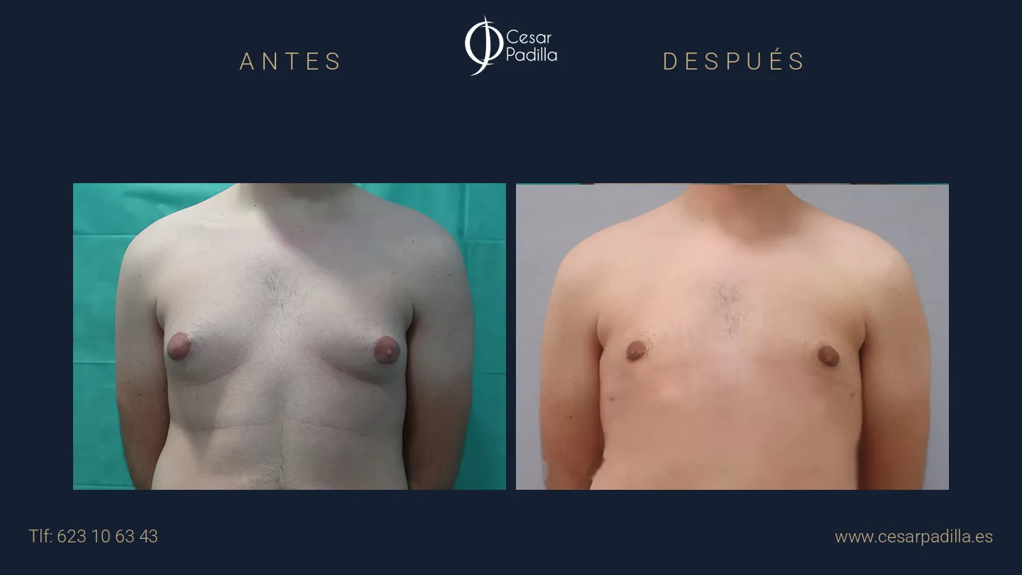 Antes y después de ginecomastia, caso 11