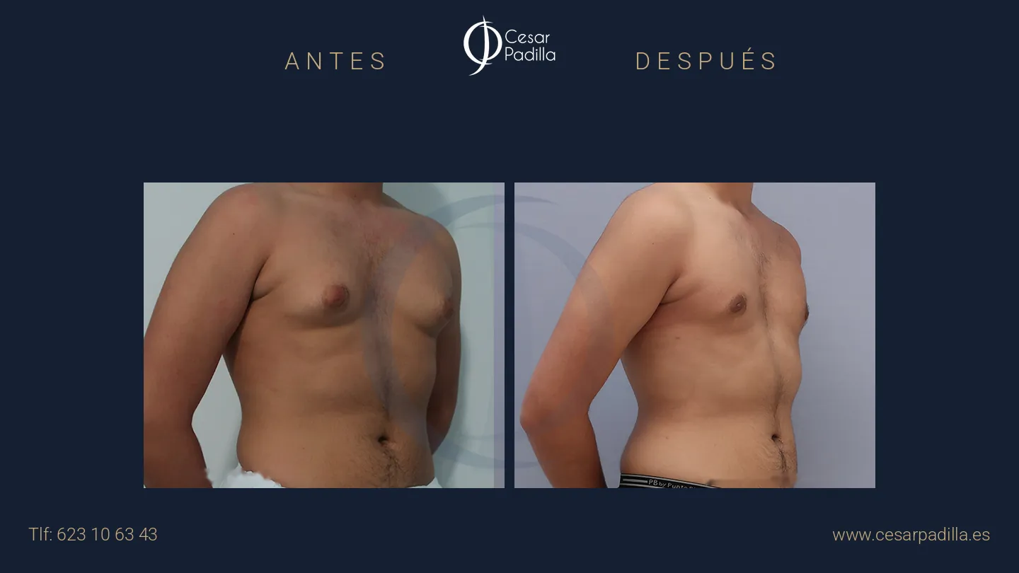 Antes y después de ginecomastia, caso 5