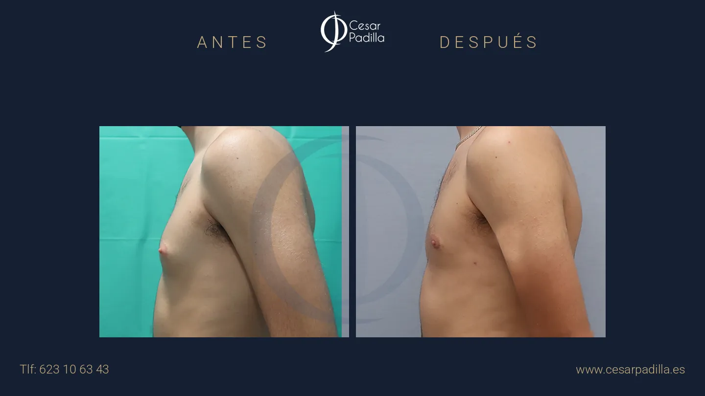 Antes y después de ginecomastia, caso 6