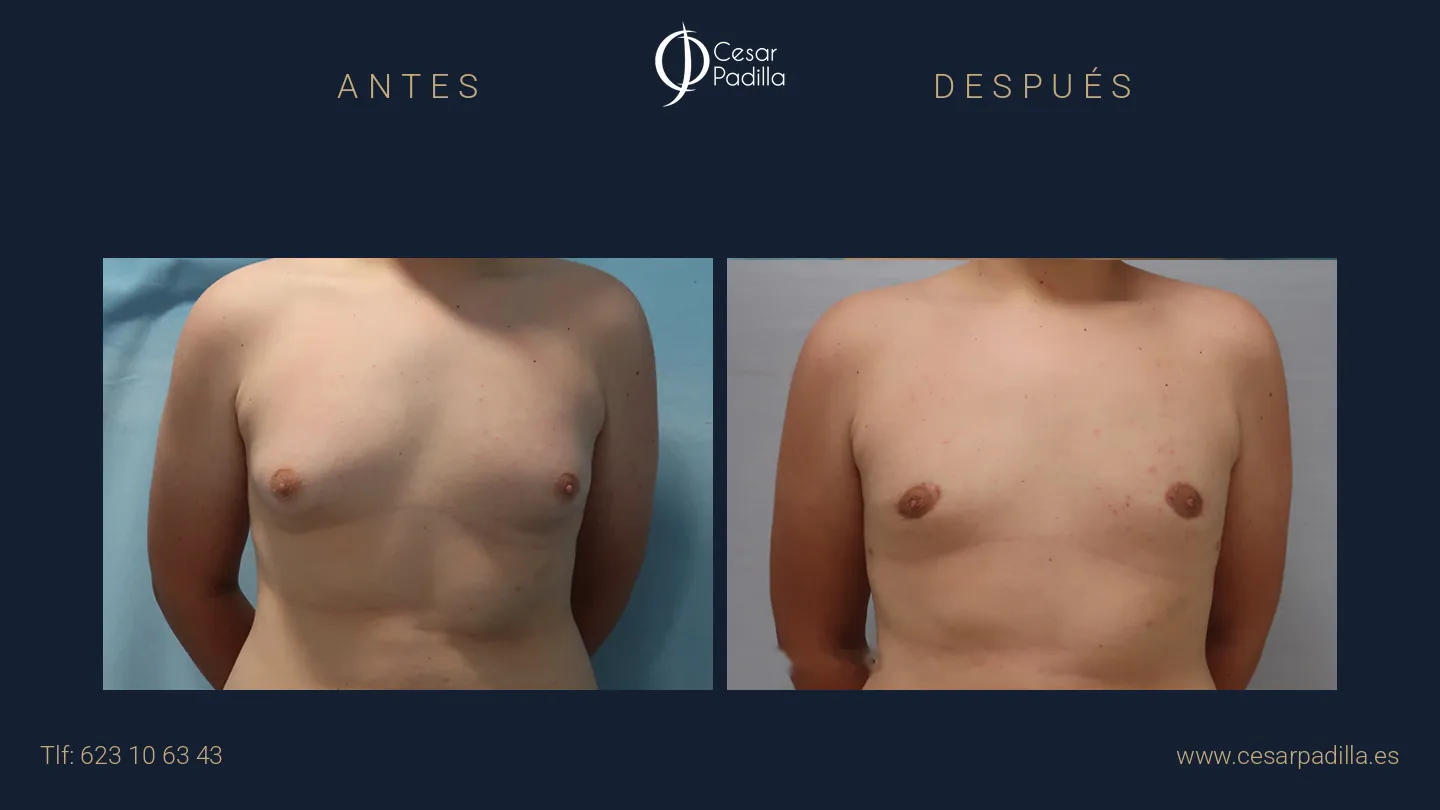 Antes y después de ginecomastia, caso 7