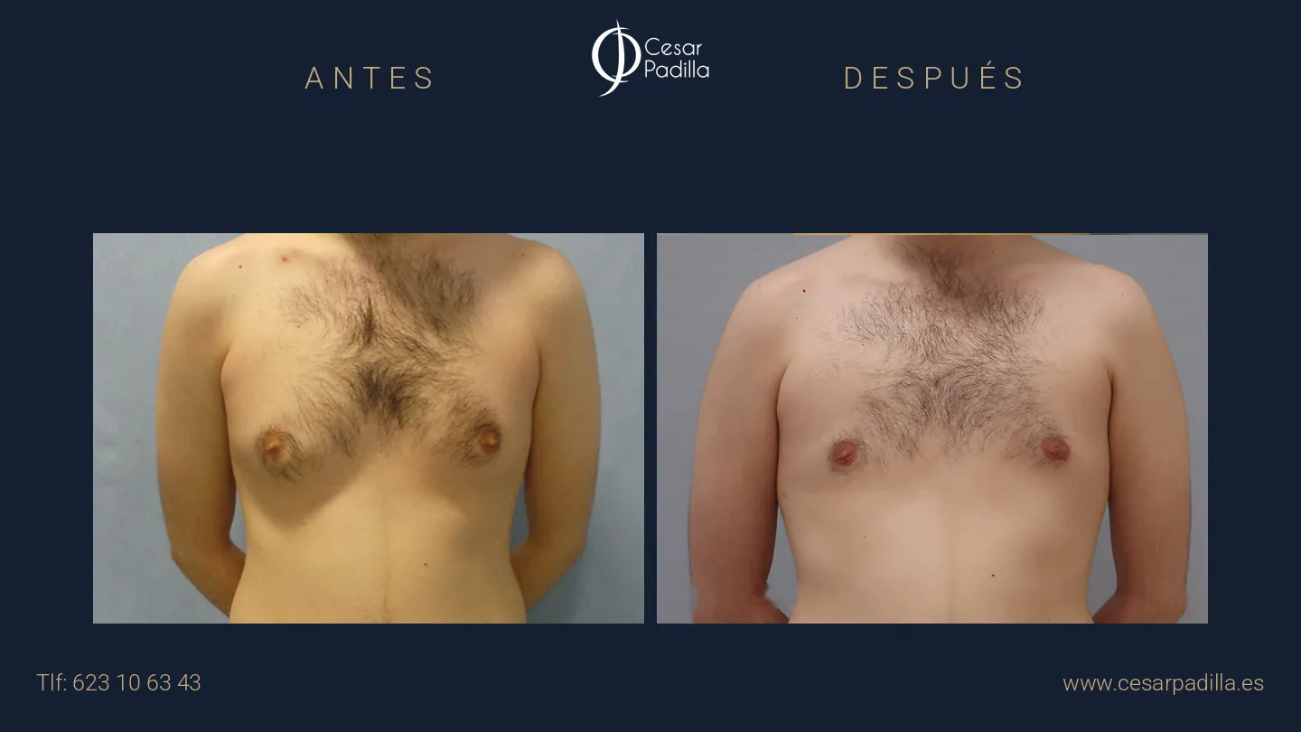 Antes y después de ginecomastia, caso 8