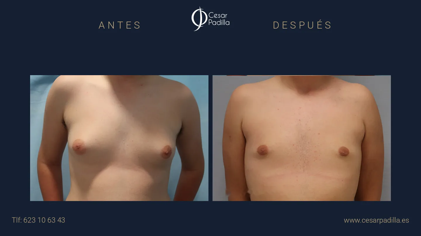 Antes y después de ginecomastia, caso 9